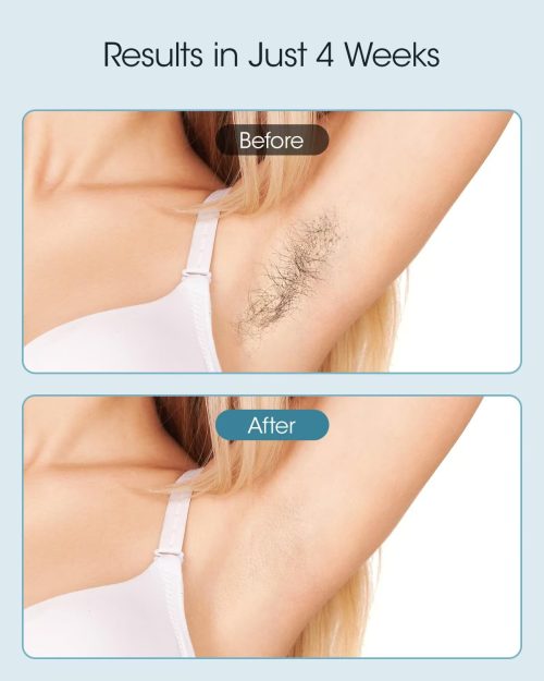 Laser Hair Removal - Ice-Cooling lPL Home Use Hair Removal for Women and Men - Nearly Painless & Long-Lasting Results - Image 3