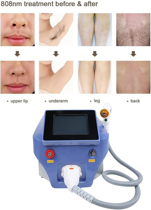 Hair Removal Machine, Vertical Type 3 Wavelength 808 Hair Remover Device Permanent Hair Remover with Cooling Function Hair Removal - Image 5
