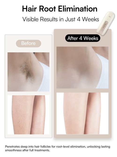 Laser Hair Removal Device for Women and Men - Image 6