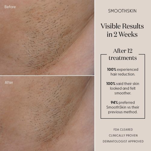 SmoothSkin Pure Adapt Champagne IPL Laser Hair Removal Device for Women & Men - Image 14