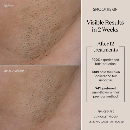 SmoothSkin Pure Adapt Champagne IPL Laser Hair Removal Device for Women & Men - Image 7