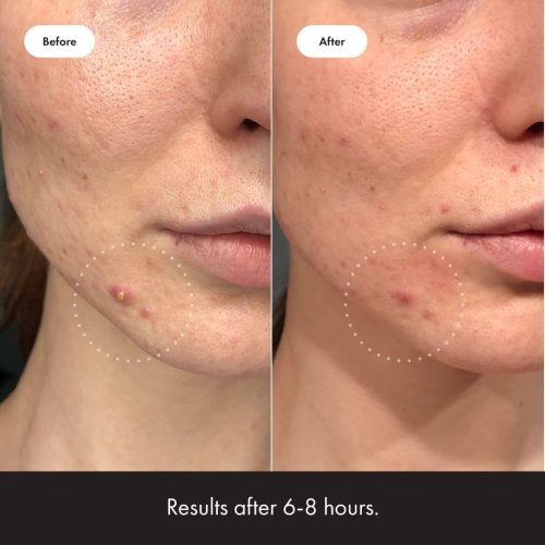 Hero Cosmetics Mighty Patch™ Invisible+ Patch - Daytime Hydrocolloid Acne Pimple Patches - Image 4