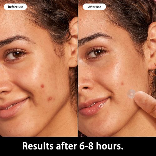 Hydrocolloid Acne Pimple Patch Kit, 72pcs Invisible Pimple Patches - Image 2