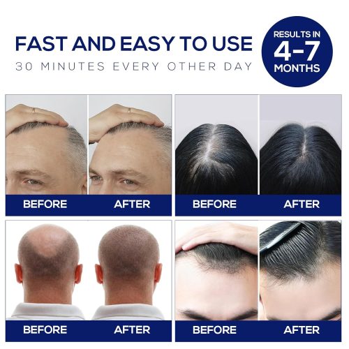 Laser Hair Growth Cap - Image 4