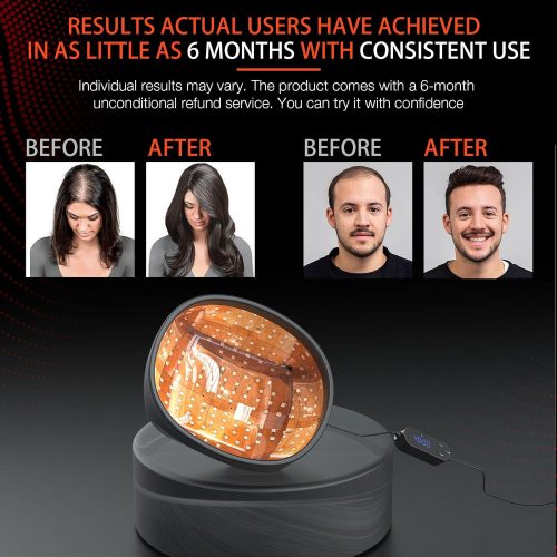 Professional Medical Grade Lasers Hair Growth Treatment Product for Men & Women, Red Light Therapy for Hair Growth - Image 5