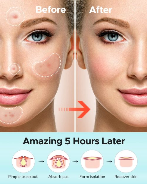 Acne Patches Large, Hydrocolloid Pimple Patches for Large Breakouts, Zit and Blemish, Large Acne Patches for Face - Image 6