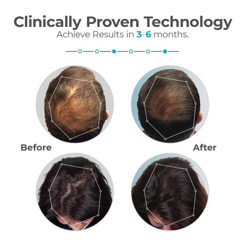 Capillus Plus Mobile Laser Therapy Cap for Hair Regrowth, with 202 Red Light - Image 3