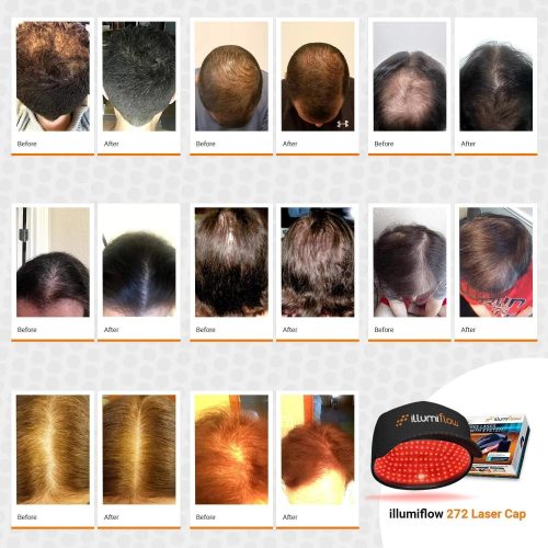 272 Laser Cap for Hair Growth - FDA Cleared Low Level Laser Therapy Hair Regrowth System for Men & Women - Image 3