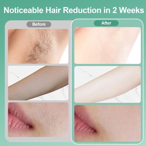 Laser Hair Removal, IPL Laser Hair Removal for Women and Men, 32°F Sapphire Ice Cooling System, Laser Hair Removal Device at Home - Image 3