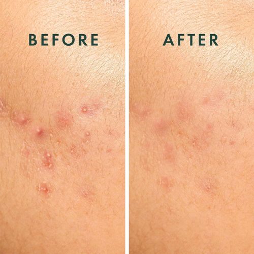 Patches Large Spot Control Cover - Hydrocolloid Acne Patches for Face, Strip for Breakouts - Image 7