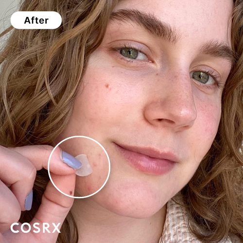 Acne Pimple Patch Absorbing Hydrocolloid Original 3 Size Patches - Image 2