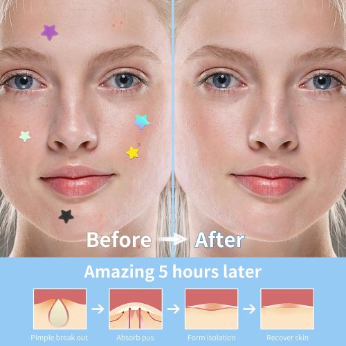Pimple Patches for Face, Cute Star Pimple Patches with Salicylic Acid - Image 3